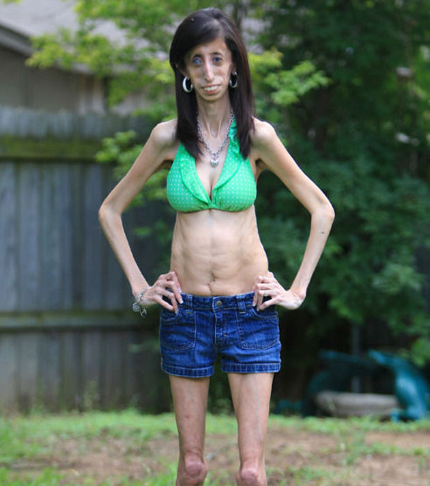 la-femme-la-plus-moche-du-monde-lizzie-velasquez-en-bikini-et-mini-short_112896_w620.jpg